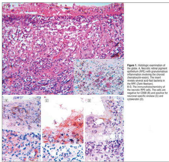 Latent-TB-infection