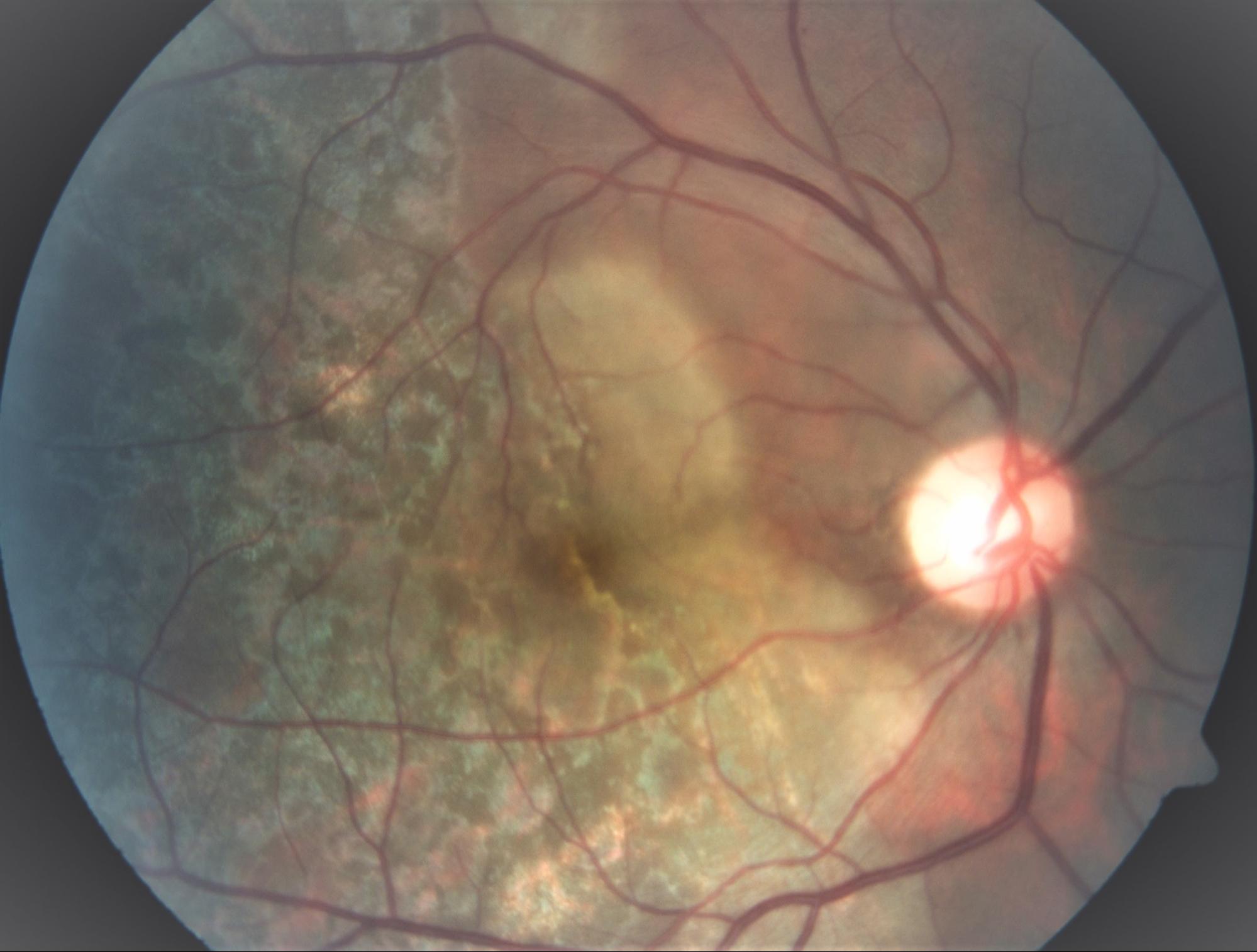 Ocular-Tuberculosis