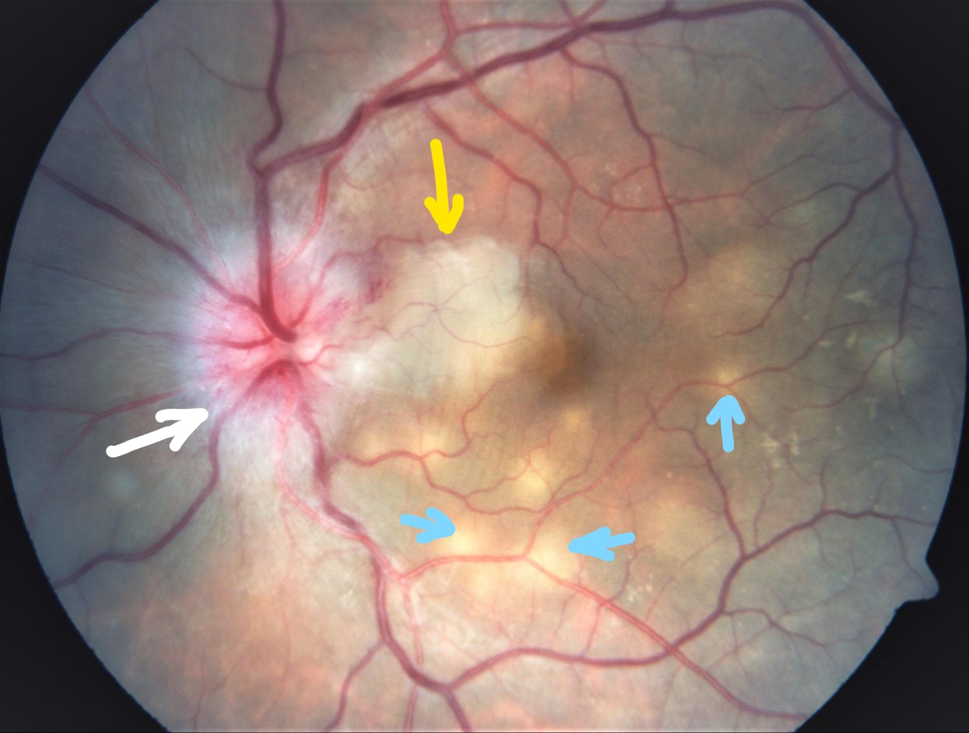 Fundus-photography