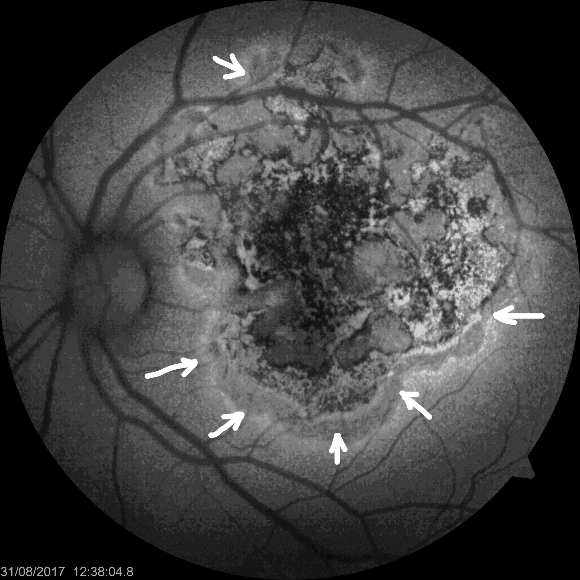 Fundus-autofluorescence