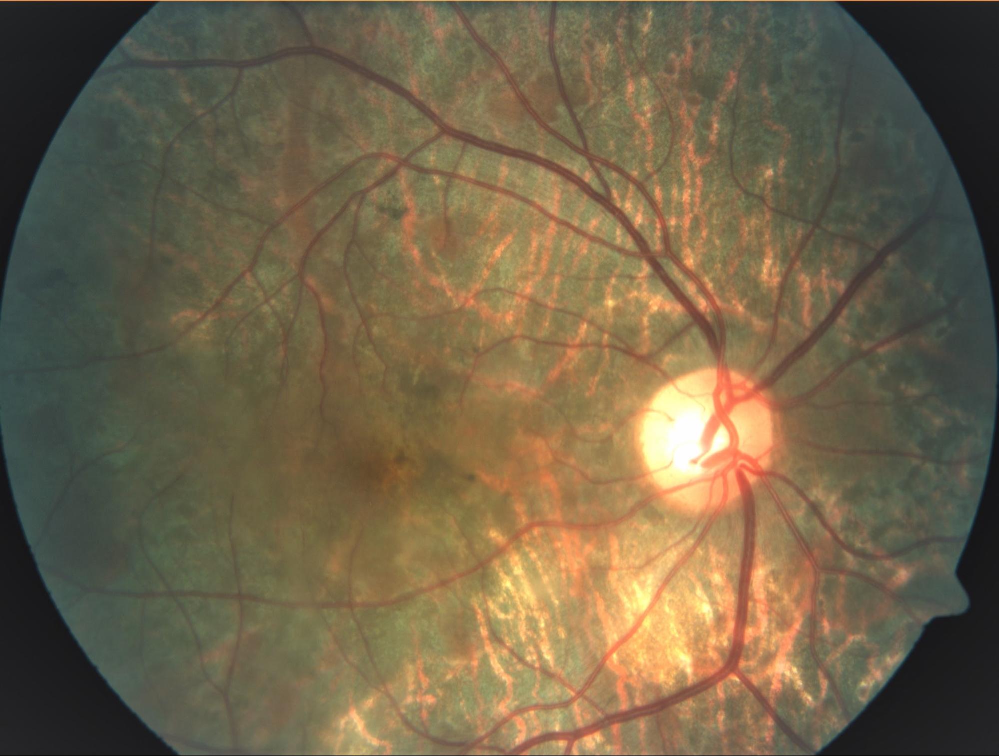 Ocular-Tuberculosis
