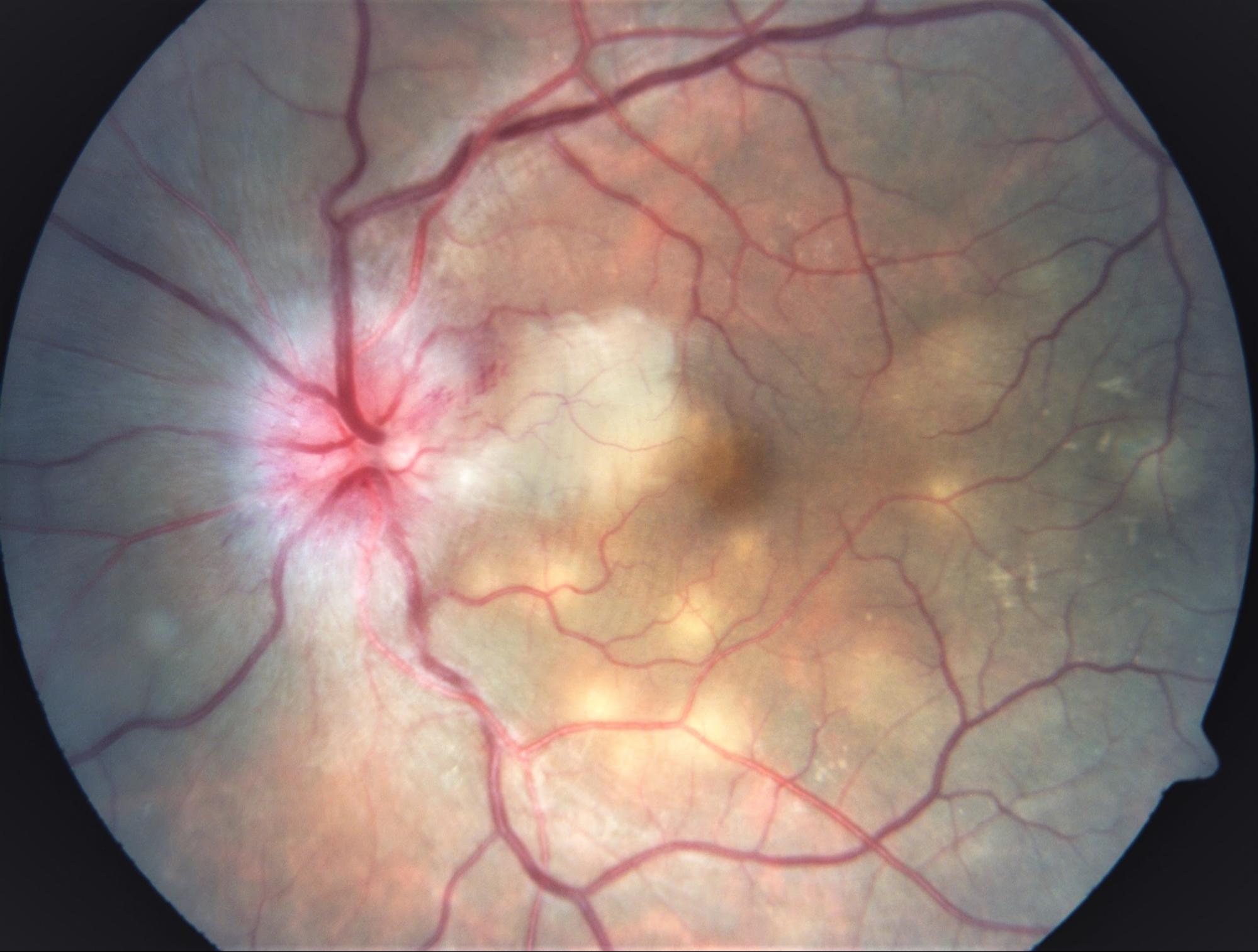 Ocular-Tuberculosis