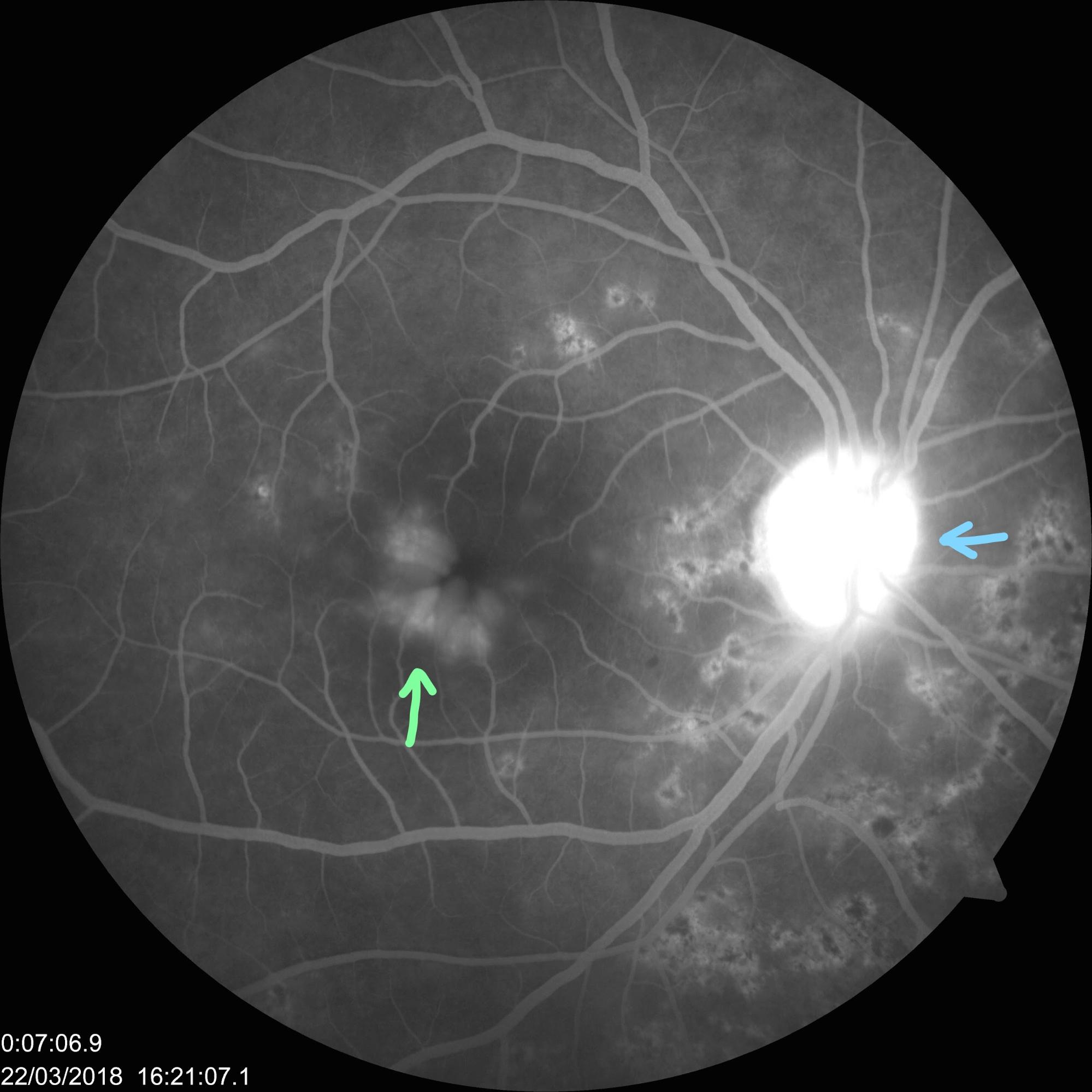 Fluorescein-angiography