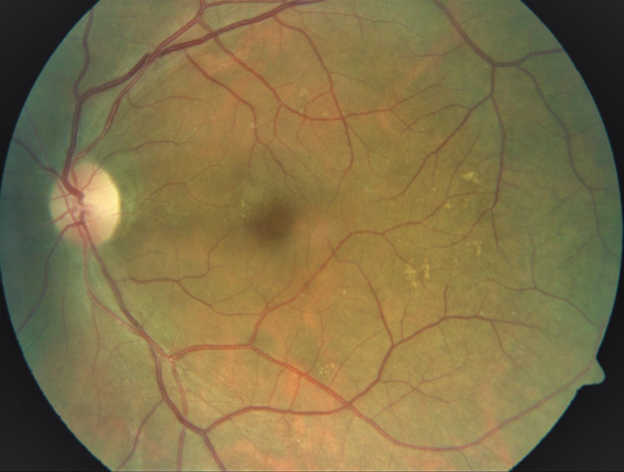 Ocular-Tuberculosis
