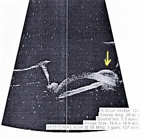 Ultrasound Biomicroscopy
