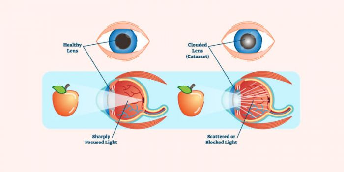 Understanding Working Lenses Cataract Types Diagnosis And Eye Care Understanding Working Lenses Cataract Types Diagnosis And Eye Care