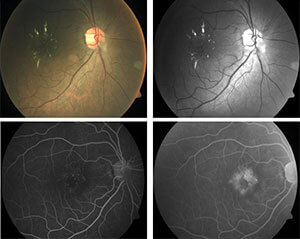 diabetic-macula-edema