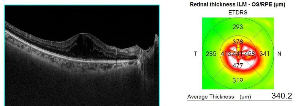 Neoretina Blog | Treat Cystoid Macular Oedema, for a better vision