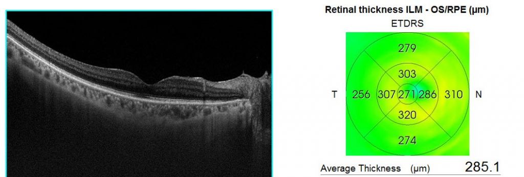 Neoretina Blog | Treat Cystoid Macular Oedema, for a better vision