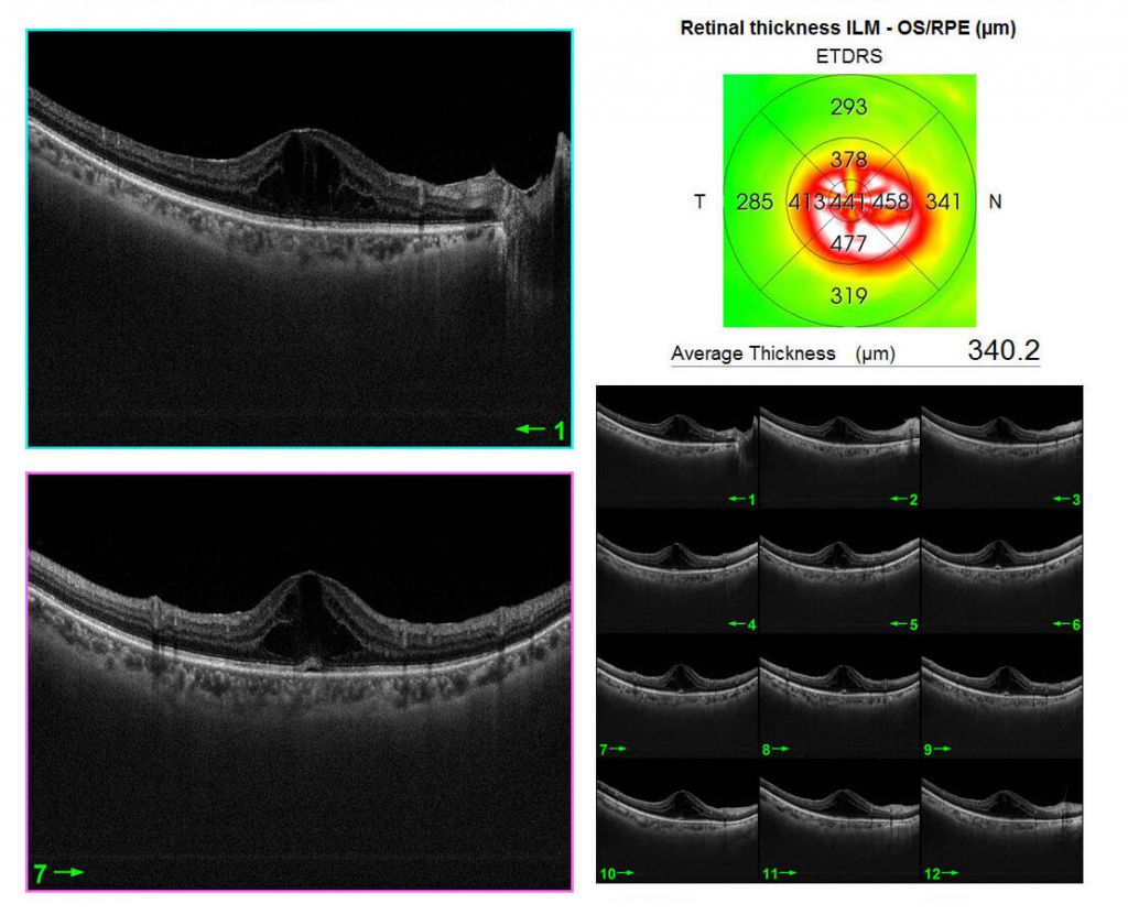 Cystoid Macular Oedema