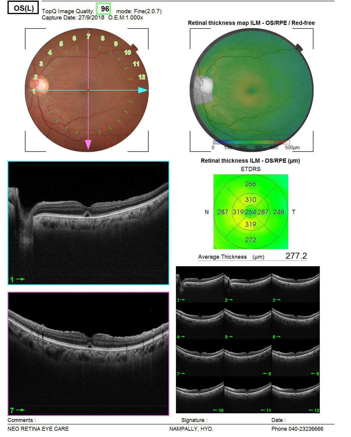 When Is It Too Late To Treat A Macular Hole Understand the symptoms, causes, treatment of a Macular Hole