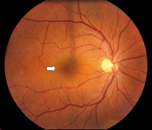 retinal-vein-occlusion