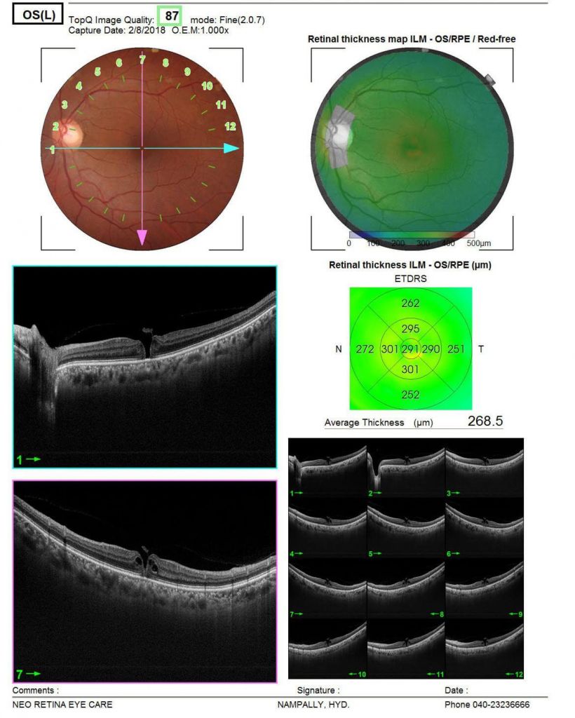 macular-hole-surgery