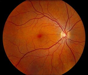 cystoid-macular-oedema