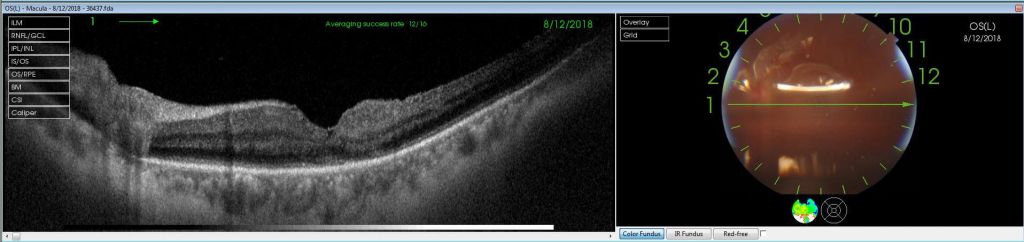 macular-hole-surgery