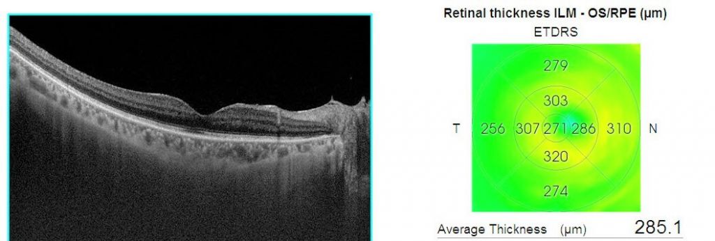 retinal-vein-occlusion