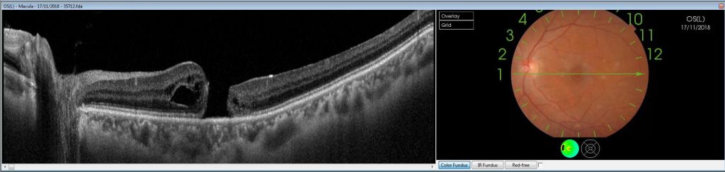 macular-hole