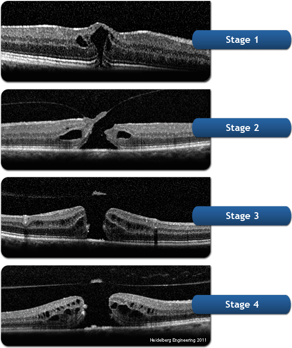 Fluorescein-angiography