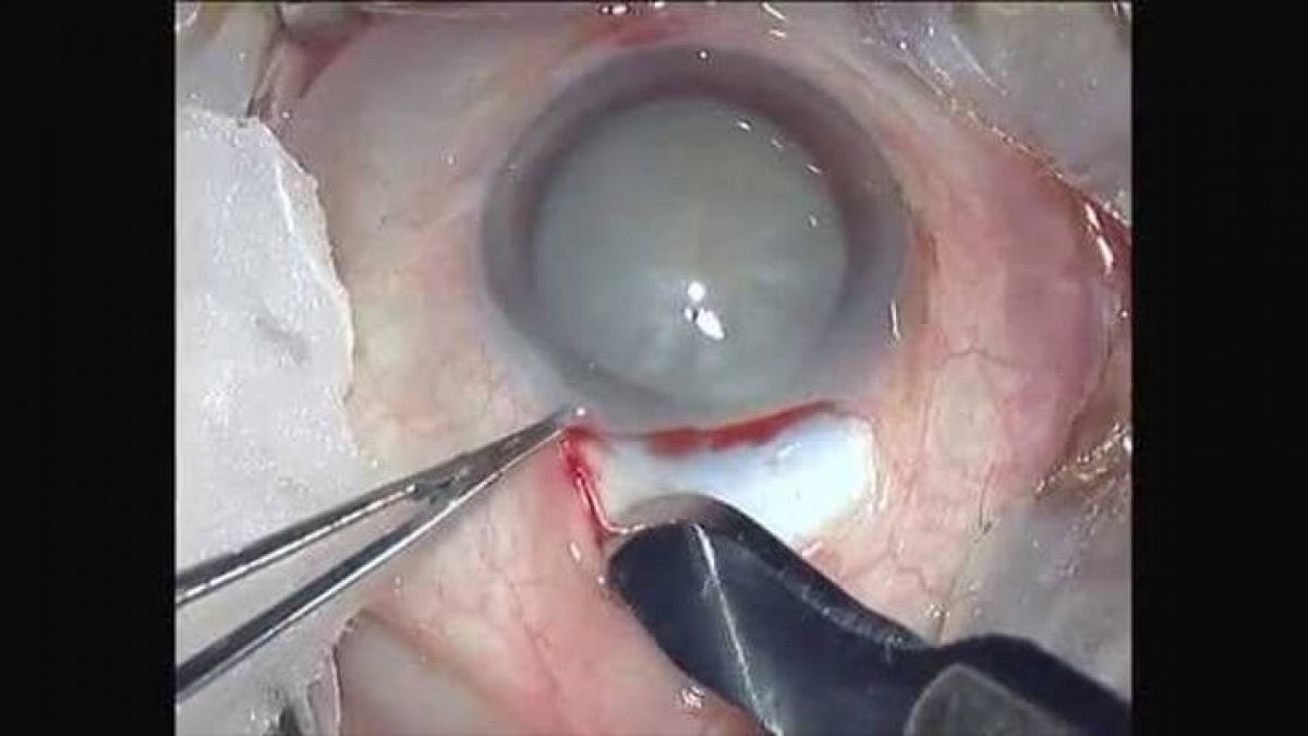 Types of Cataract Surgery - Advances and Benefits | NeoRetina