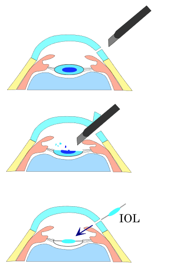 Phacoemulsification