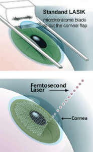 Femtosecond LASIK surgery