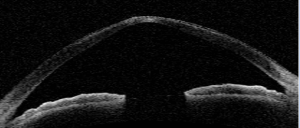 Neoretina Blog | Keratoconus Screening and Treatment