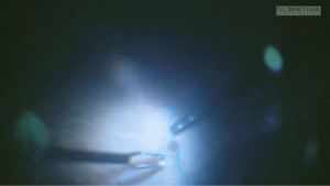 macular hole