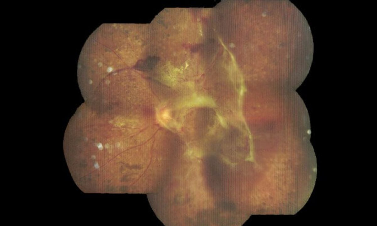 Diabetic Vitrectomy Everything You Need to Know About the Procedure