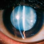 complicated cataract