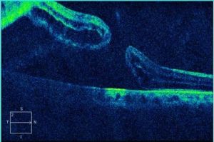 OCT scan of full thickness macular hole