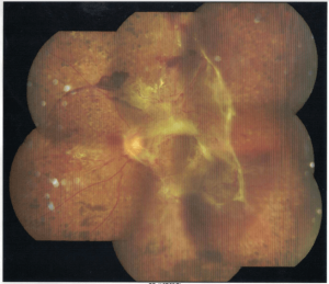 Diabetic retinopathy with tractional retinal detachment