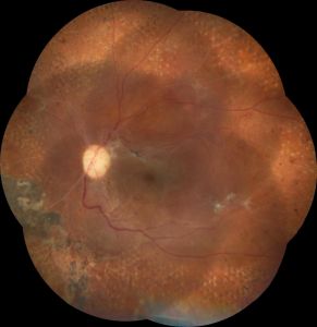after diabetic vitrectomy