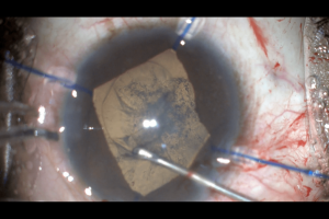 Complicated cataract surgery in progress with the help of iris hooks