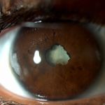 complicated cataract