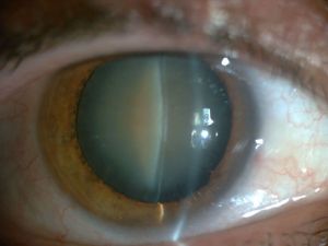 Nuclear senile cataract