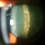 complicated cataract