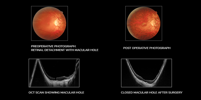 Retinal Detachment Treatment Solutions for Optimal Eye Health
