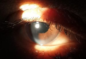 cataract surgery