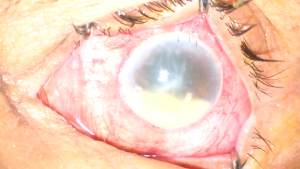 Endophthalmitis