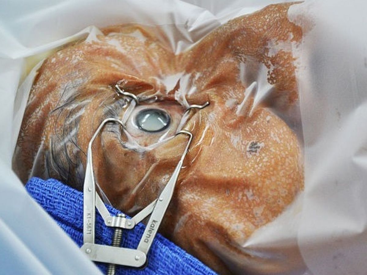 Safety From Covid 19 During Cataract Surgery