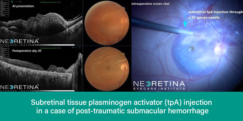 Subretinal tissue plasminogen activator (tpA) injection in a case of