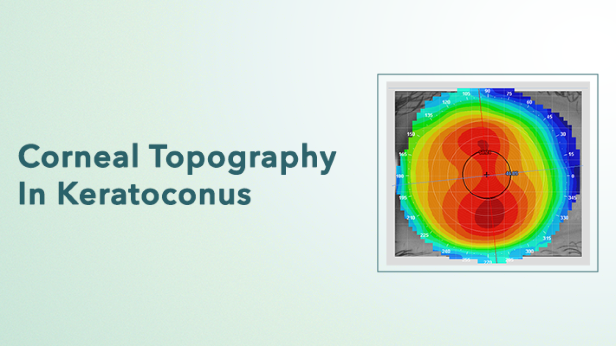 Advanced Corneal Topography Interpretation for Keratoconus Management