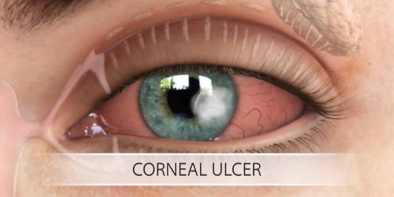 neoretina corneal ulcers